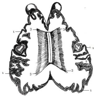 Cerebral hemisphere sliced to show the corpus callosum (1-Gray matter, 2-White Matter, 3-Carpus callosom - Corpus callosum - vetscraft