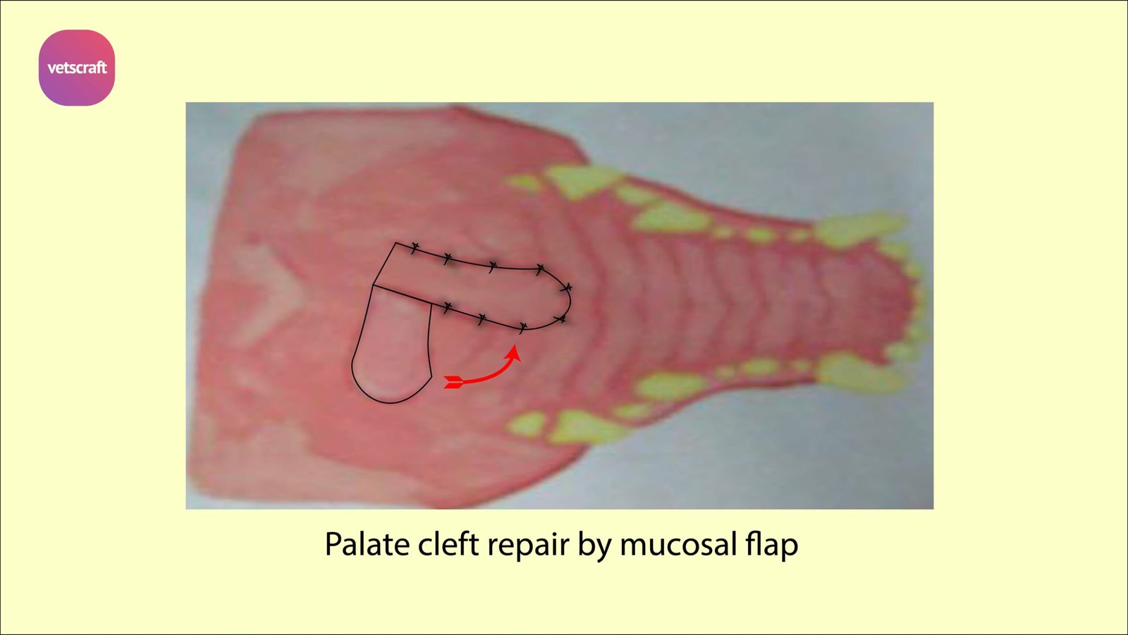 Palate cleft repair by mucosal flap - Surgical affections of soft and hard palate