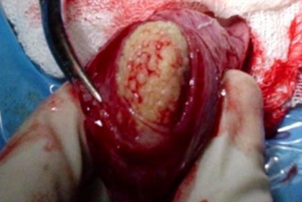 Cystotomy in a female dog showing single calculus removal- Affections of Kidney and urinary system