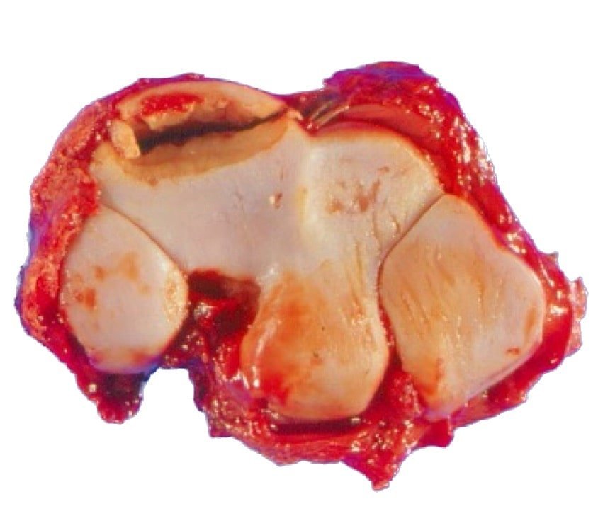 Gross image of a slab fracture of the radial facet of the third carpal bone- Fracture of carpal bone