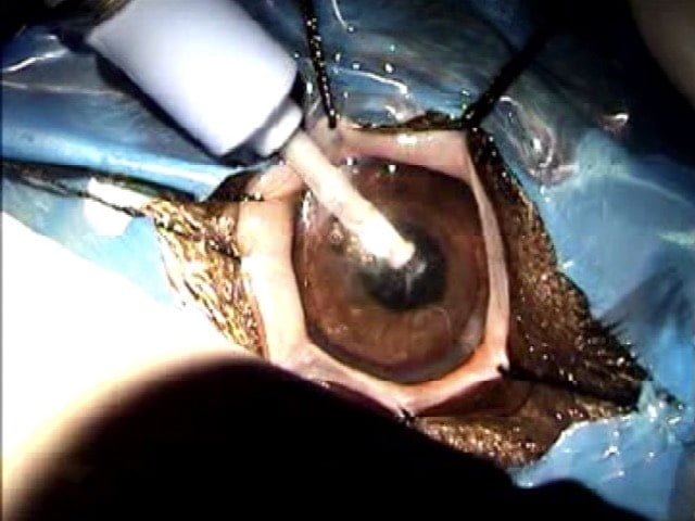 Phacoemulsification in progress