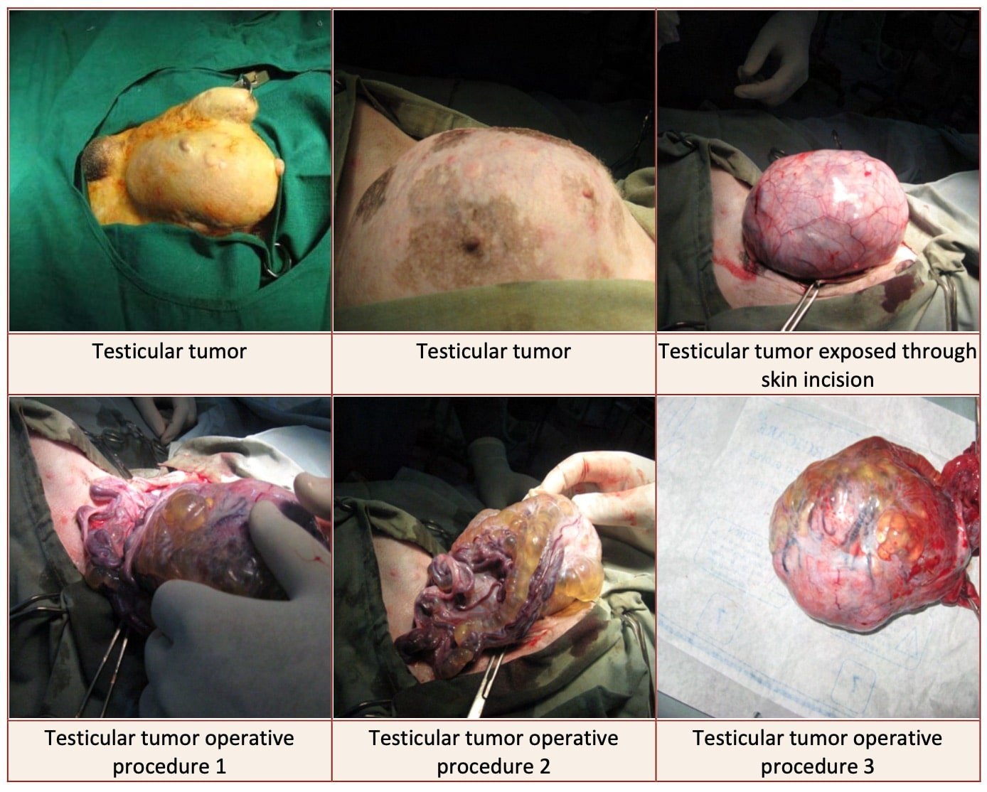 Tumors of testicles and surgical removal- Surgical affections of testicle and Scrotum