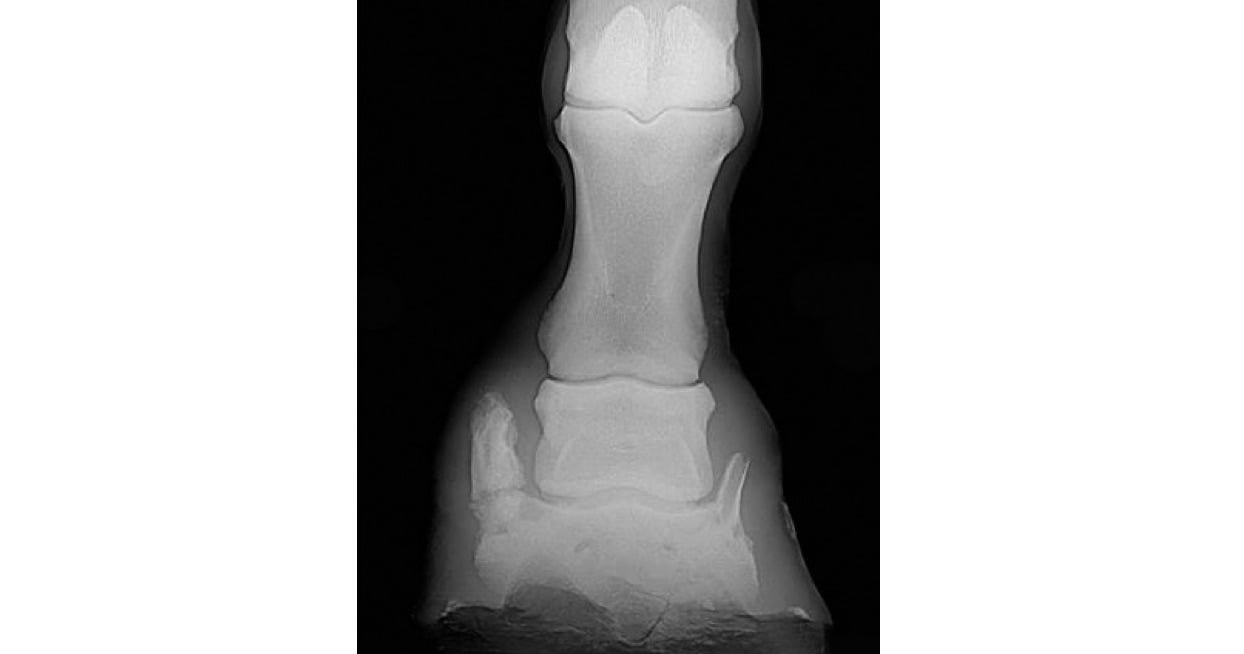 Ossification of the collateral cartilages of the distal phalanx- Standing dorsopalmar horse demonstrating a large uniaxial sidebone that was thought to contribute to lameness