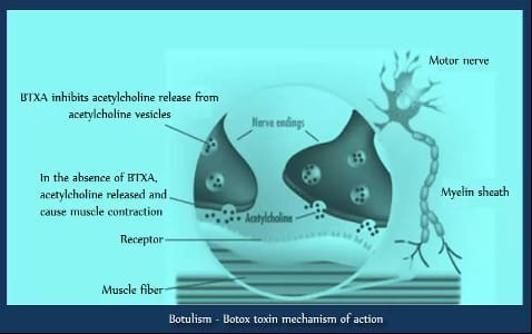 Botulism- Botox toxin mechanism of action